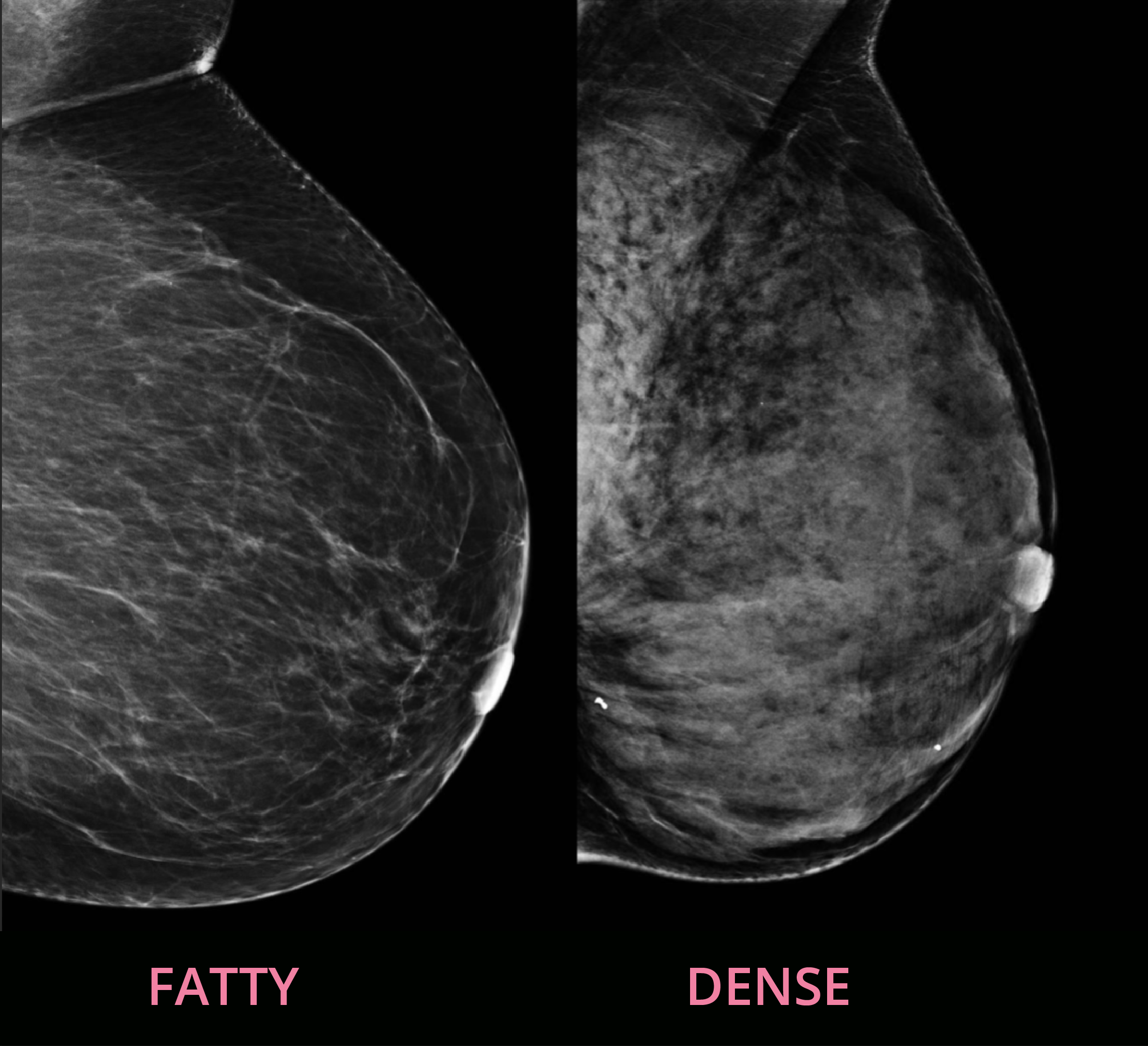 Dense Breast Tissue  Breast Density and Mammogram Reports