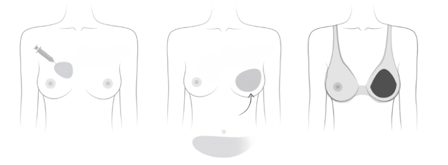 Options after lumpectomy