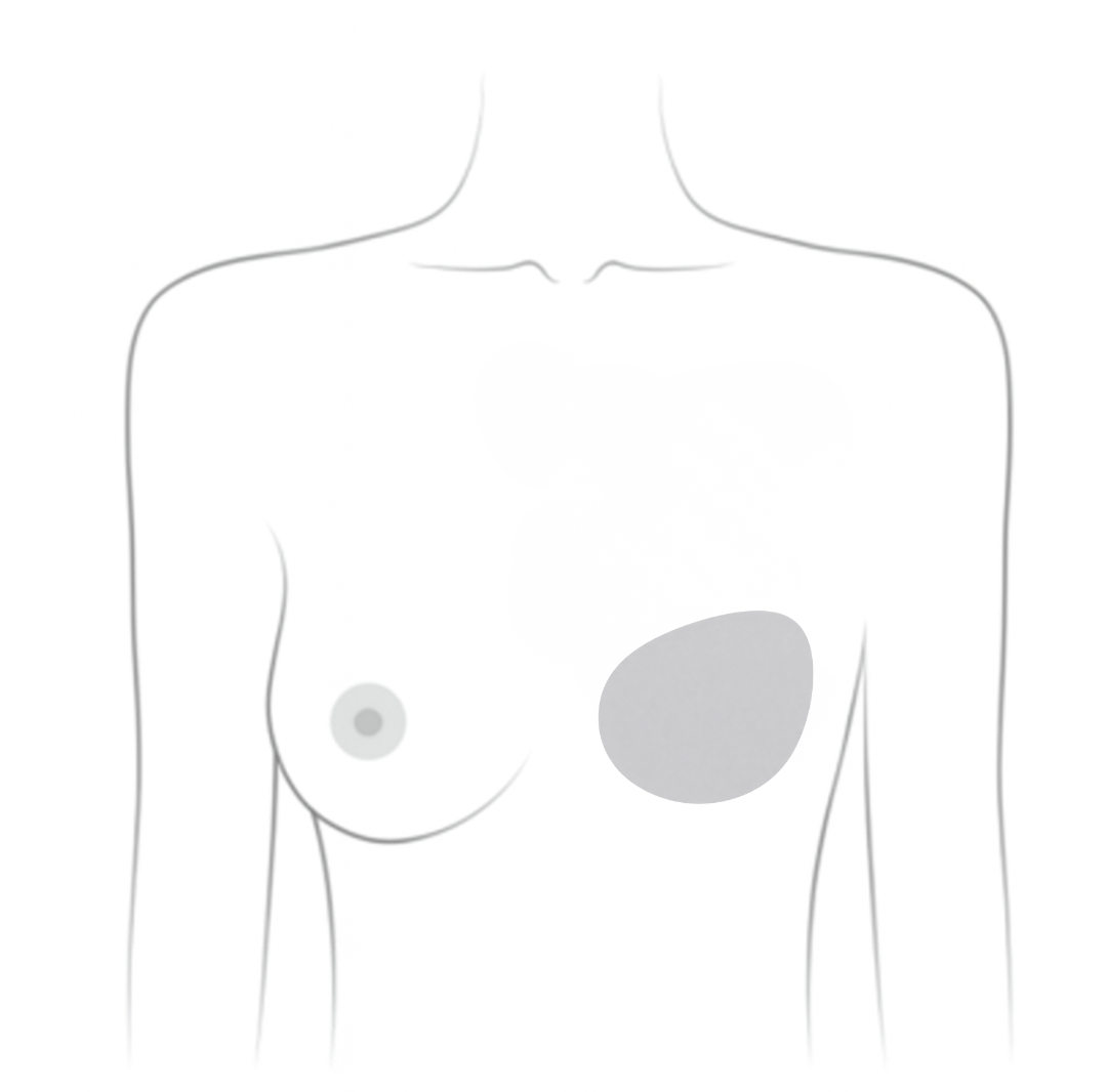 Mastectomy