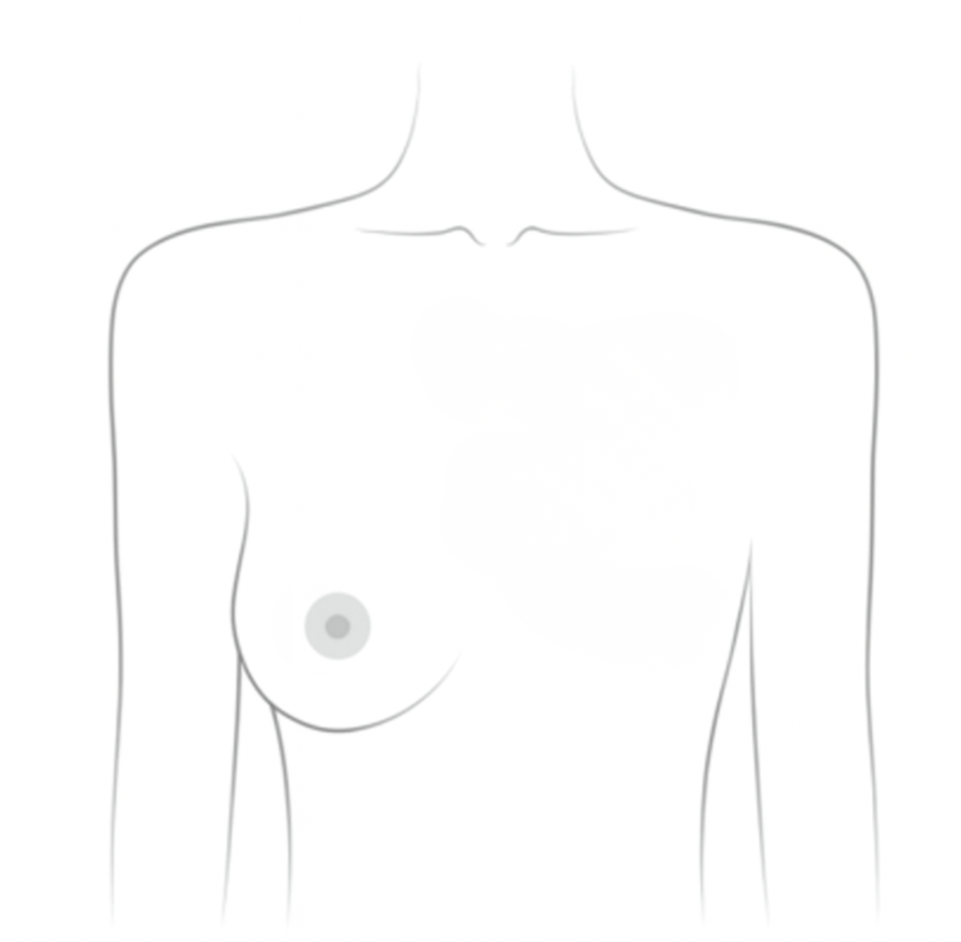 Living Flat or Asymmetrical (No Reconstruction)