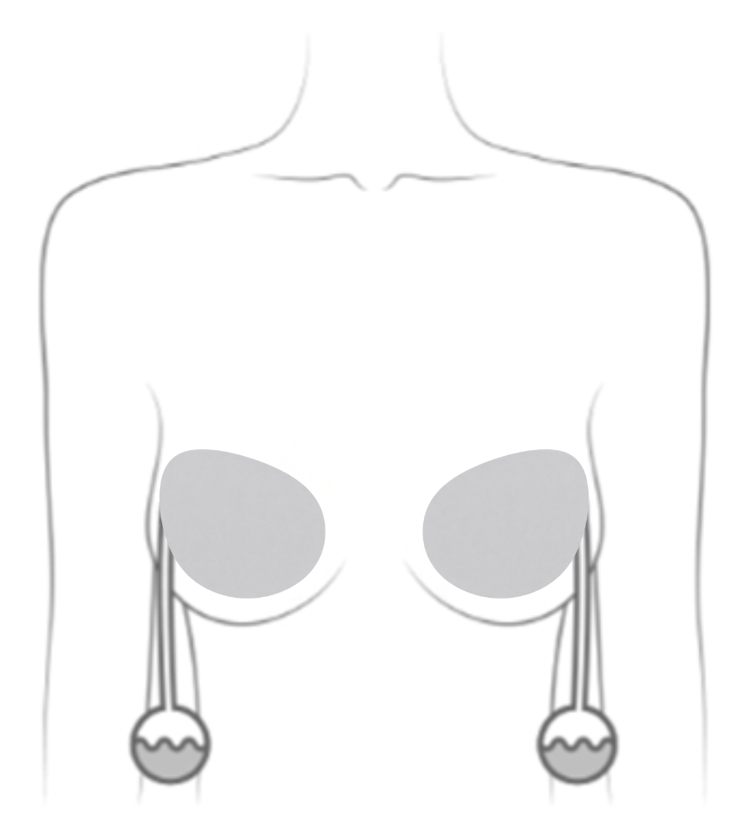 Immediate Reconstruction